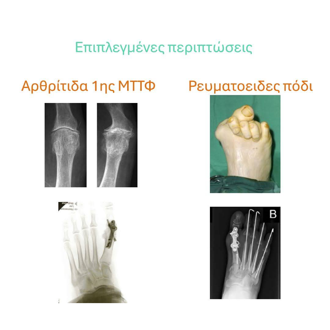 Κλινική εικόνα βλαισού μεγάλου δακτύλου
