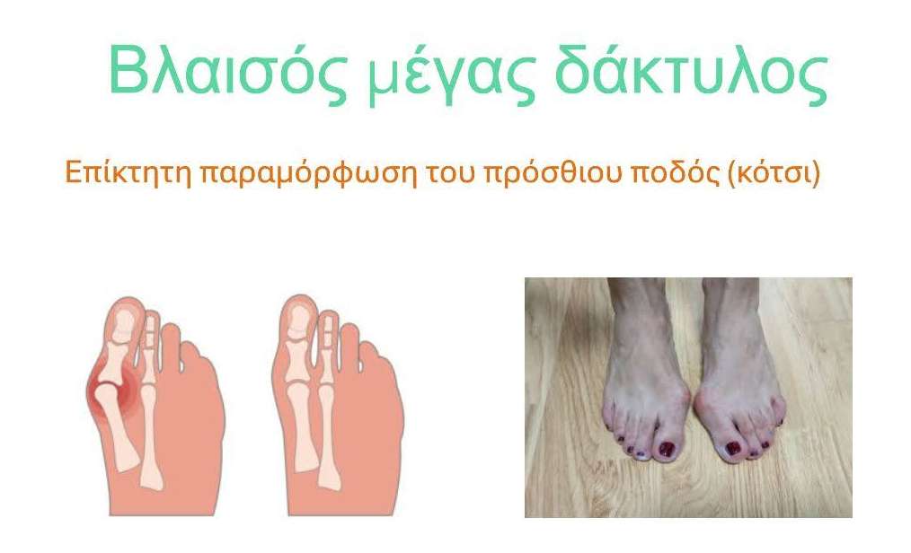 Εικόνα για το άρθρο: Βλαισός μέγας δάκτυλος